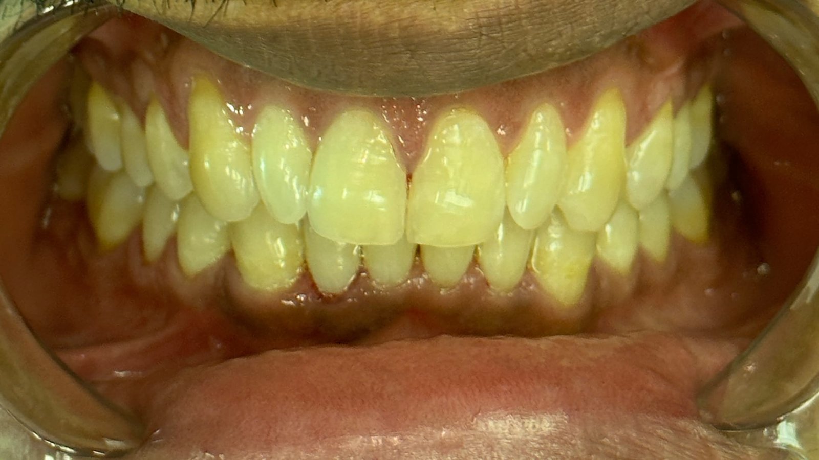 1jpg Dental Alignment