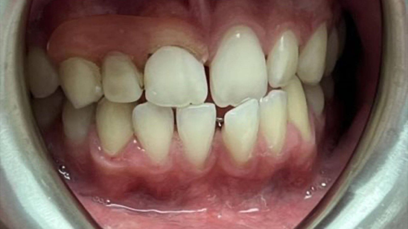 2jpg Crooked Teeth