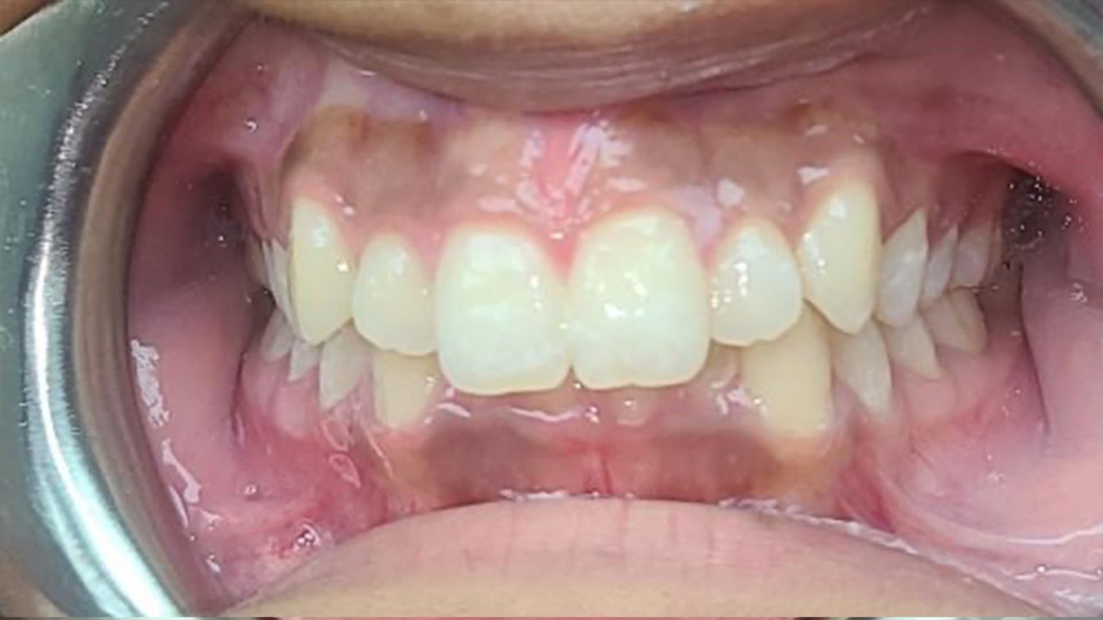 3jpg Teeth Alignment