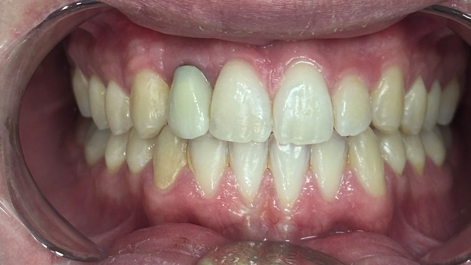 4jpg Dental Veneers