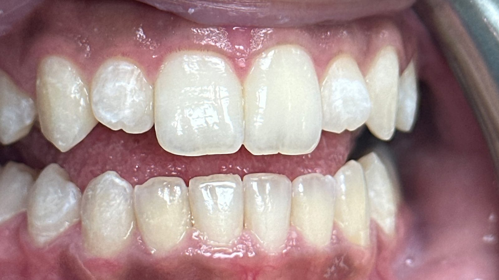 5jpg Composite Fillings