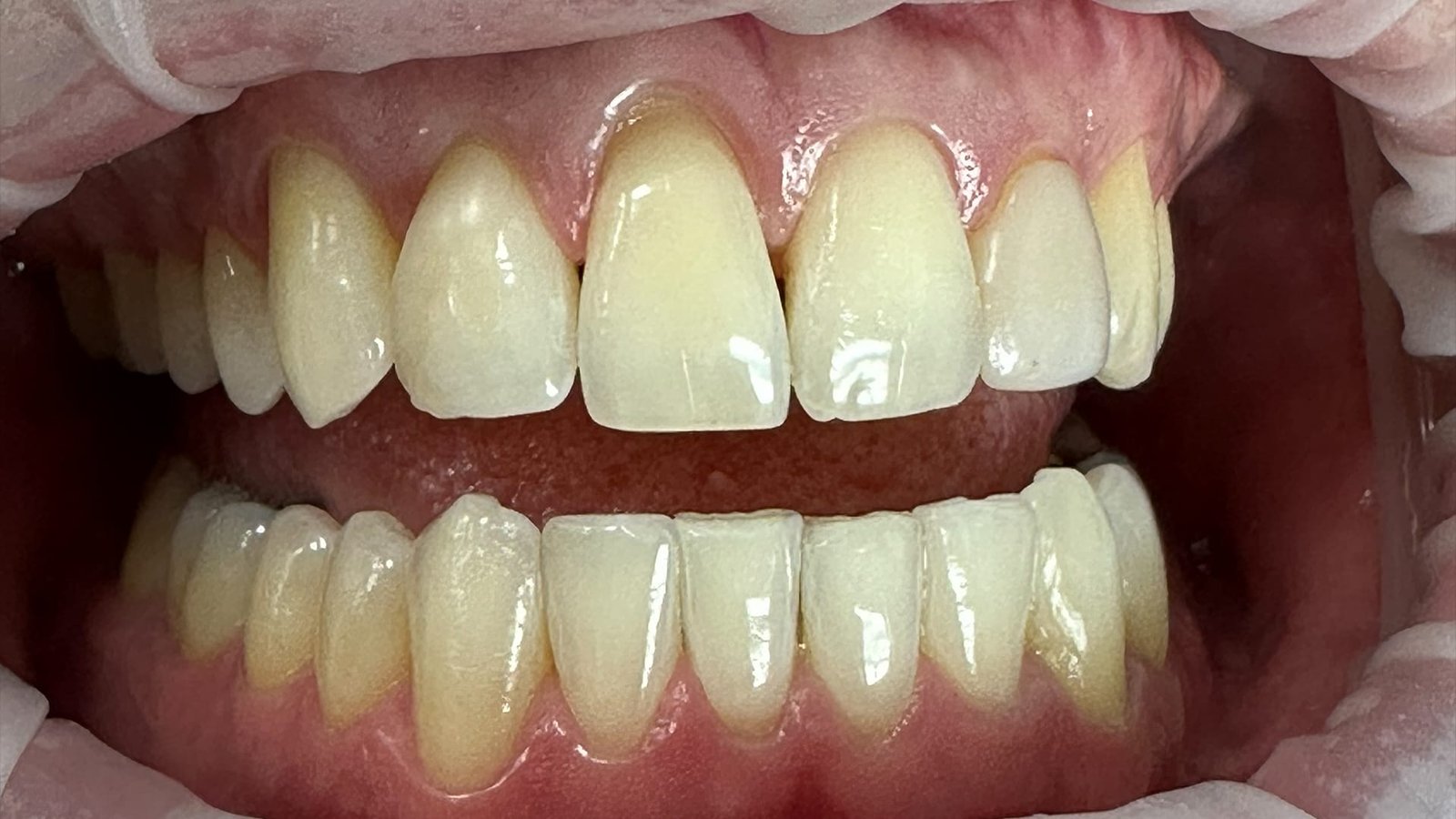 6jpg Dental Veneers